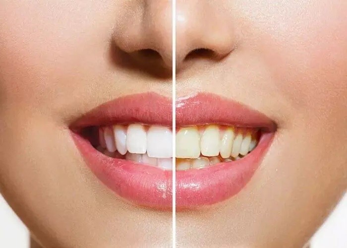 ऐसे पाएं दांतों के पीलेपन से छुटकारा - Teethwhitening Tips