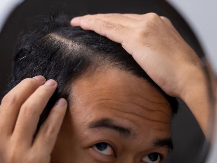 किस विटामिन की कमी से झड़ते हैं सिर के बाल ?