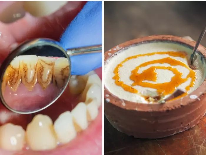 How To Remove Plaque From Teeth : ये 5 देसी नुस्खे प्लाक की समस्या को करेंगे दूर
