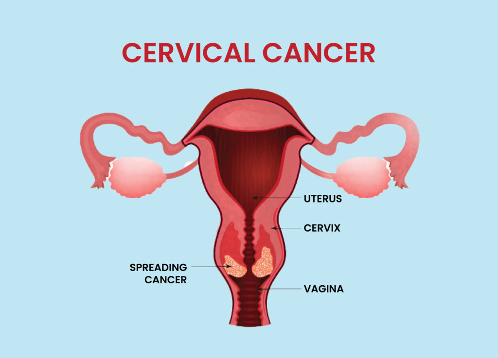 Cervical Cancer 1 सर्वाइकल कैंसर क्या है? - What is Cervical Cancer?